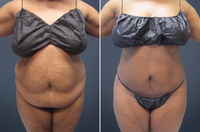 Tummy Tuck result at David W. Allison, MD in Philadelphia, PA