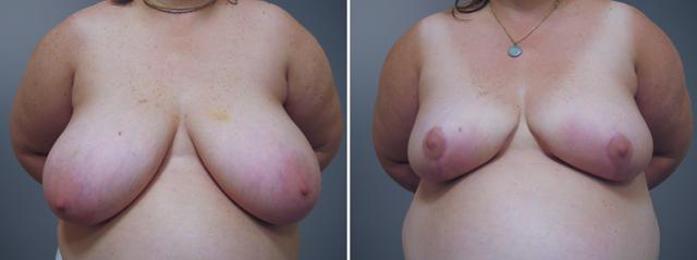Breast Augmentation result at David W. Allison, MD in Philadelphia, PA