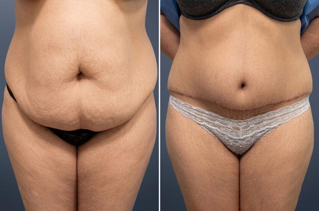 Tummy Tuck result at David W. Allison, MD in Philadelphia, PA