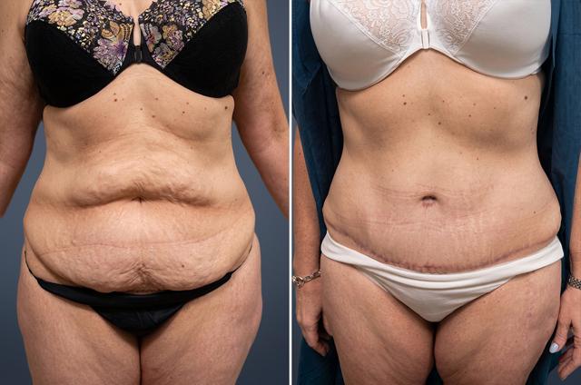 Tummy Tuck result at David W. Allison, MD in Philadelphia, PA