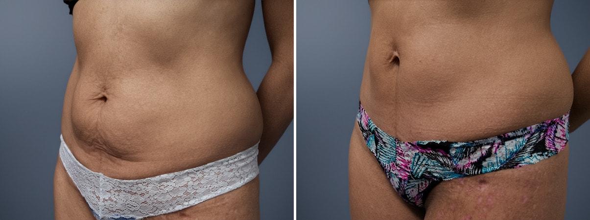 David W. Allison, MD tummy tuck result — Philadelphia, PA