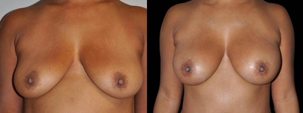 Premier Plastic Surgery (Christopher Hankins, MD) breast augmentation result — Pearland, TX