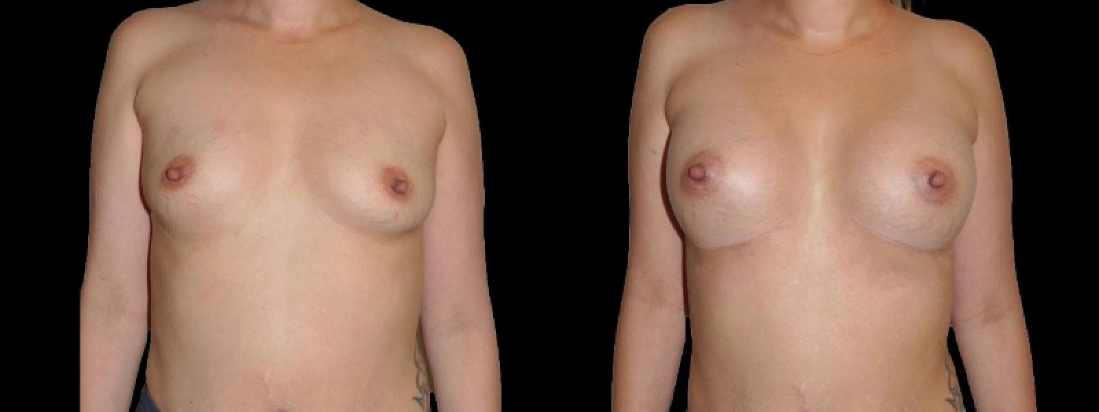 Premier Plastic Surgery (Christopher Hankins, MD) breast augmentation result — Pearland, TX