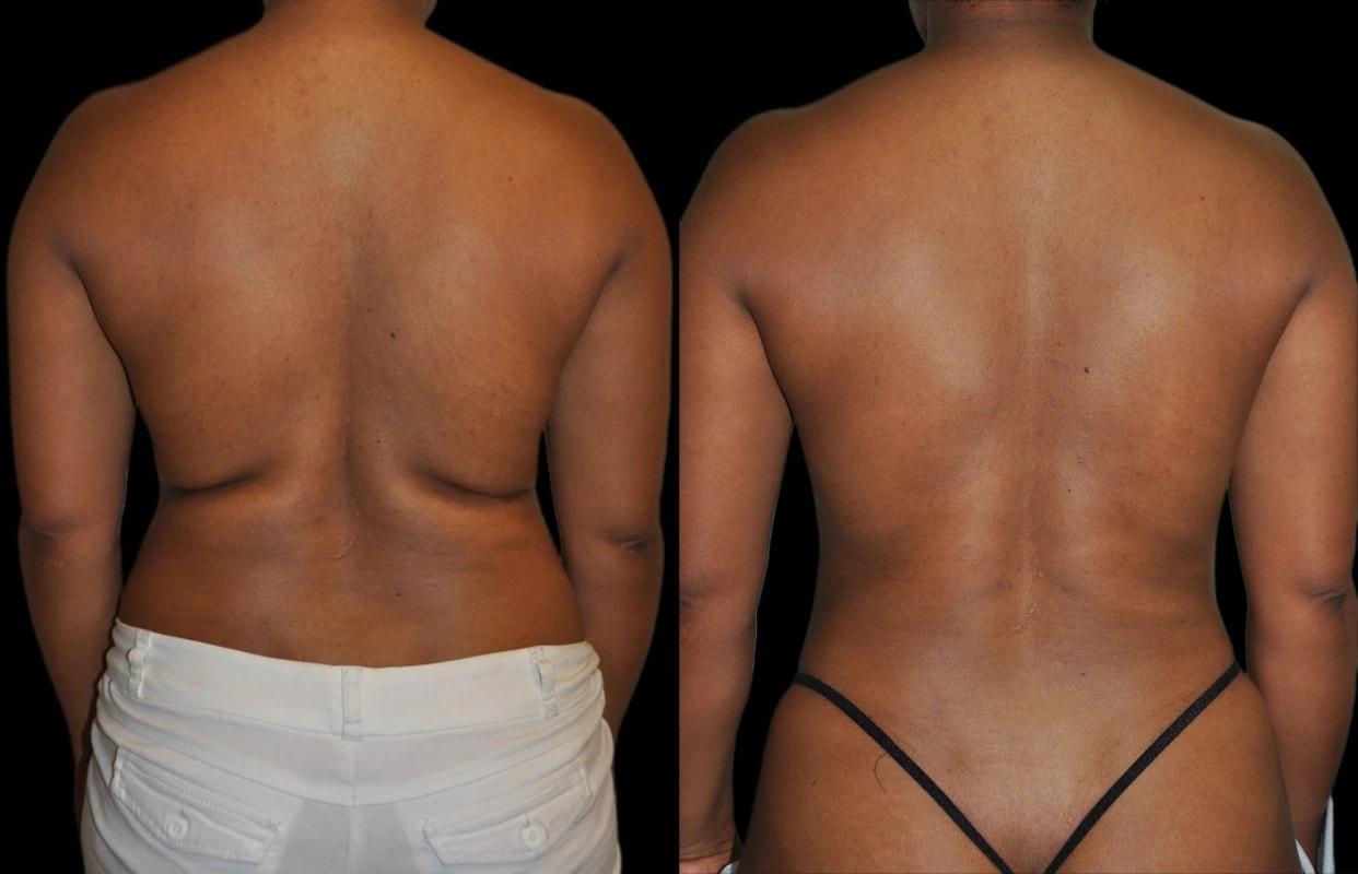 Premier Plastic Surgery (Christopher Hankins, MD) liposuction result — Pearland, TX