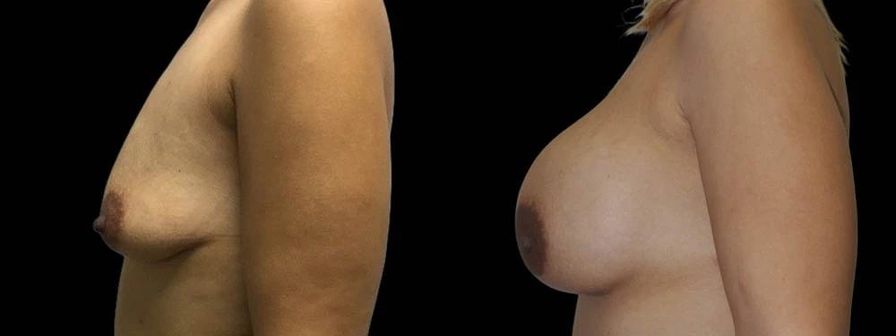 Premier Plastic Surgery (Christopher Hankins, MD) breast augmentation result — Pearland, TX