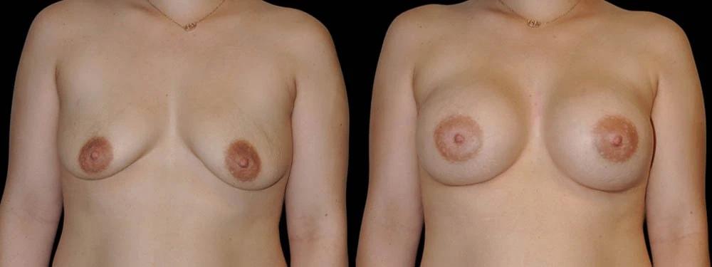 Premier Plastic Surgery (Christopher Hankins, MD) breast lift result — Pearland, TX