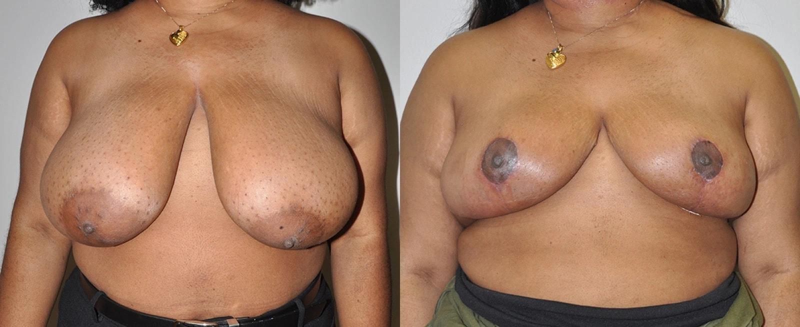 Premier Plastic Surgery (Christopher Hankins, MD) breast reduction result — Pearland, TX