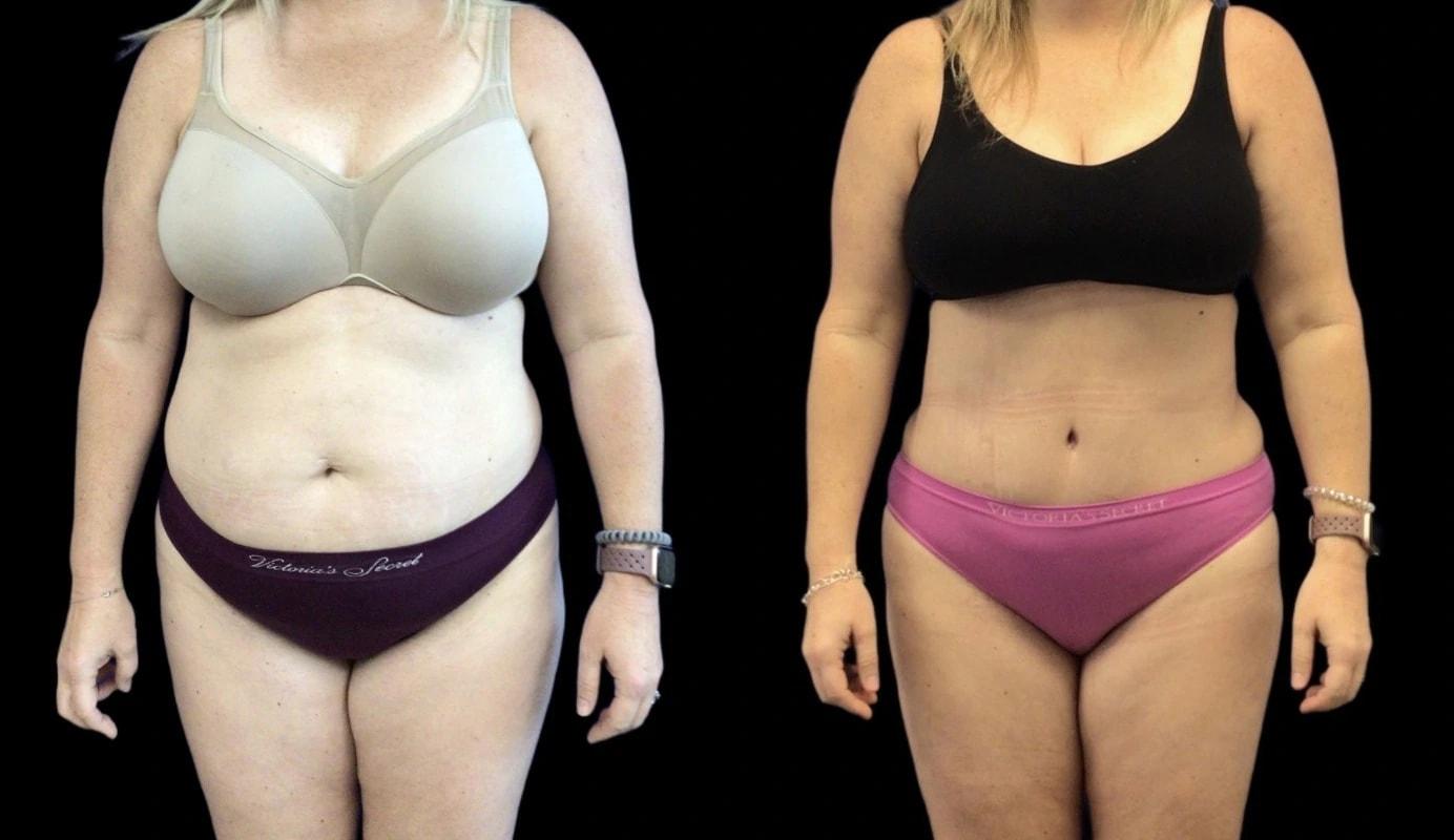 Premier Plastic Surgery (Christopher Hankins, MD) liposuction result — Pearland, TX