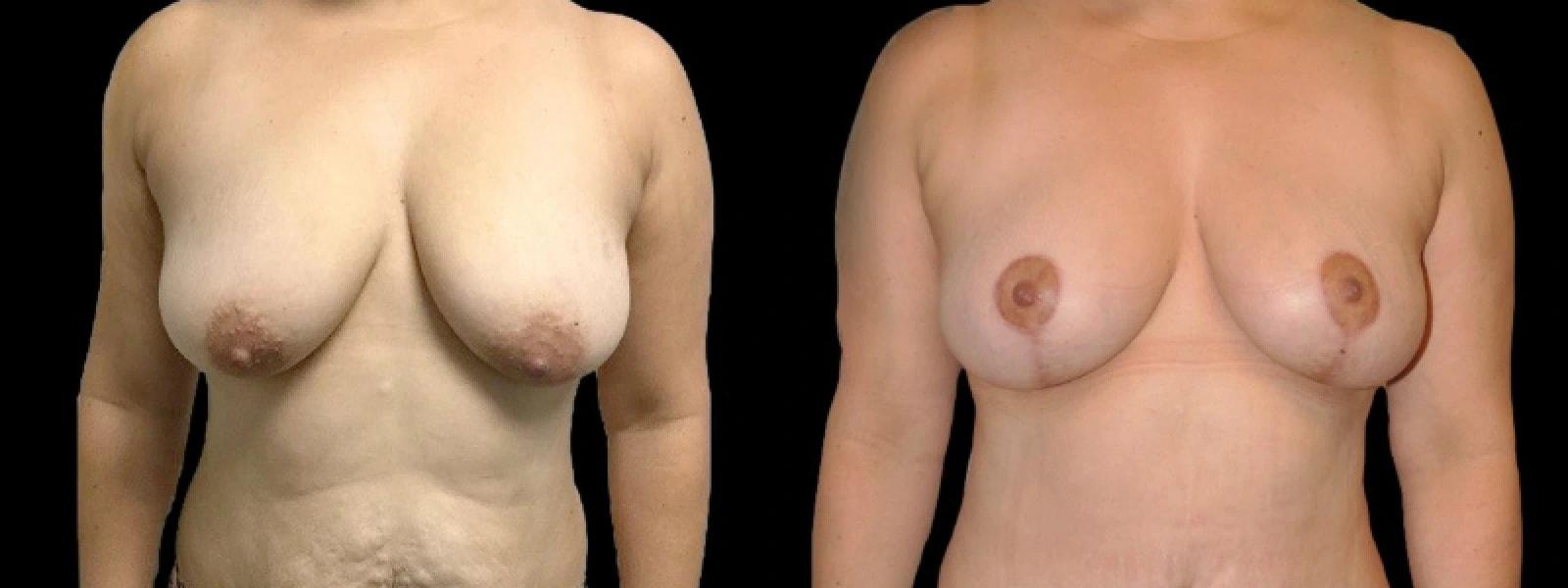Premier Plastic Surgery (Christopher Hankins, MD) breast lift result — Pearland, TX