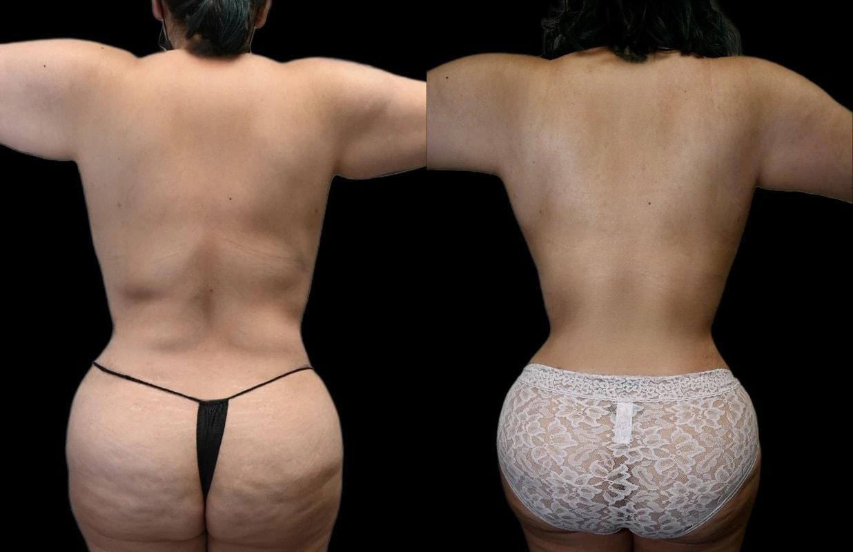 Premier Plastic Surgery (Christopher Hankins, MD) liposuction result — Pearland, TX