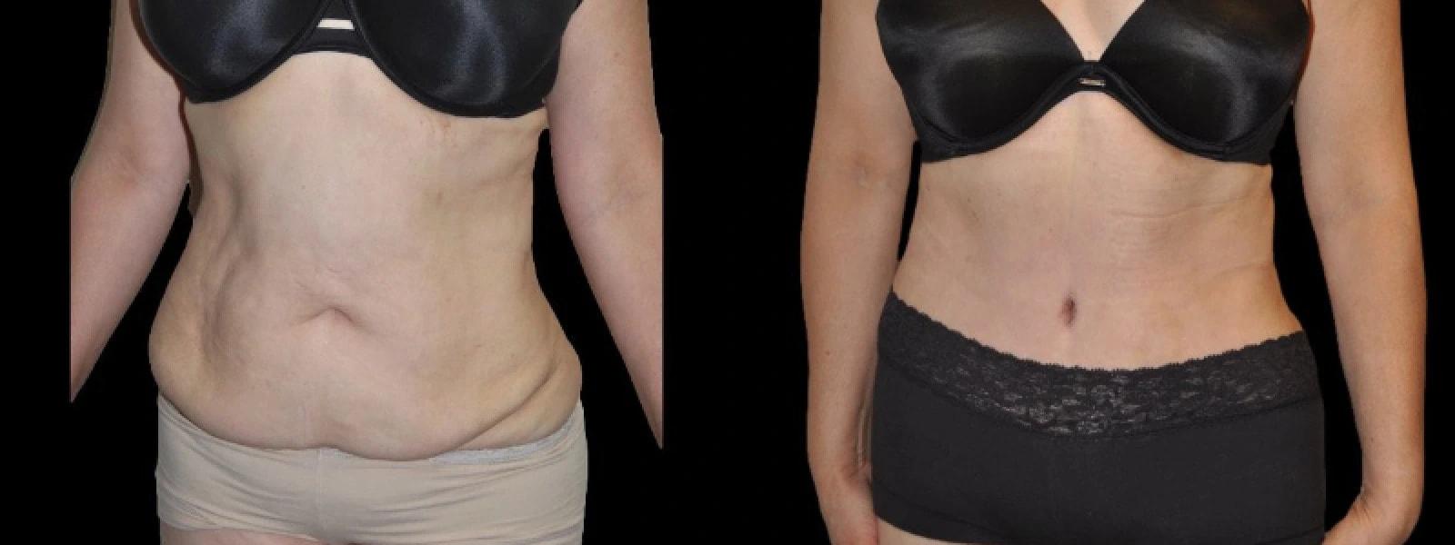 Premier Plastic Surgery (Christopher Hankins, MD) tummy tuck result — Pearland, TX