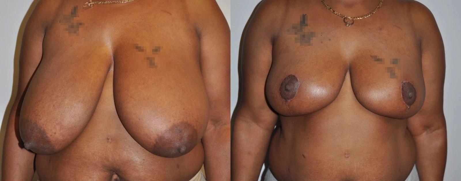 Premier Plastic Surgery (Christopher Hankins, MD) breast reduction result — Pearland, TX