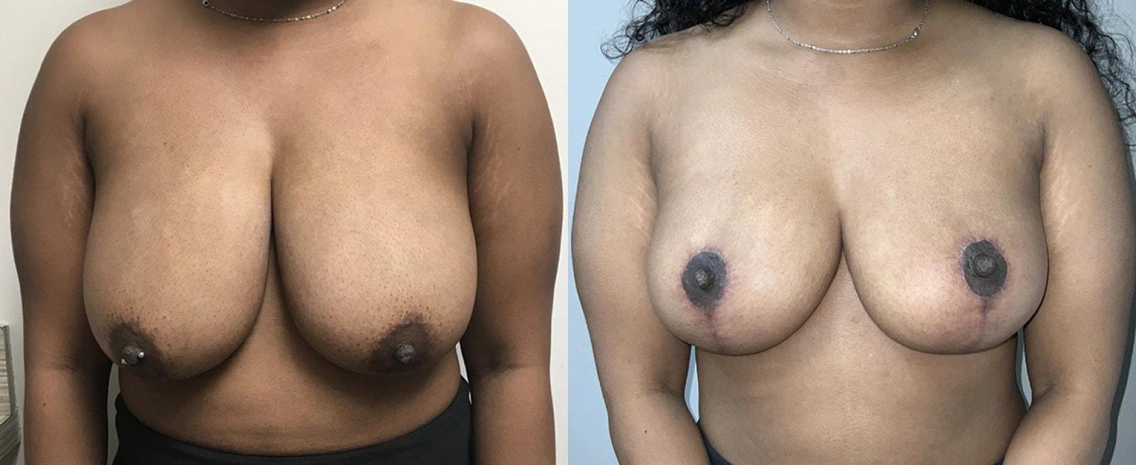 Premier Plastic Surgery (Christopher Hankins, MD) breast reduction result — Pearland, TX