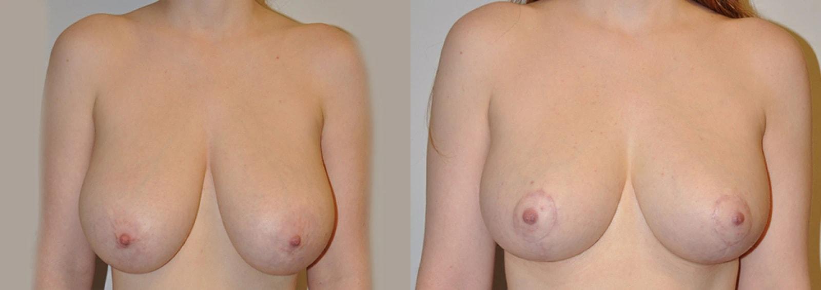 Premier Plastic Surgery (Christopher Hankins, MD) breast reduction result — Pearland, TX