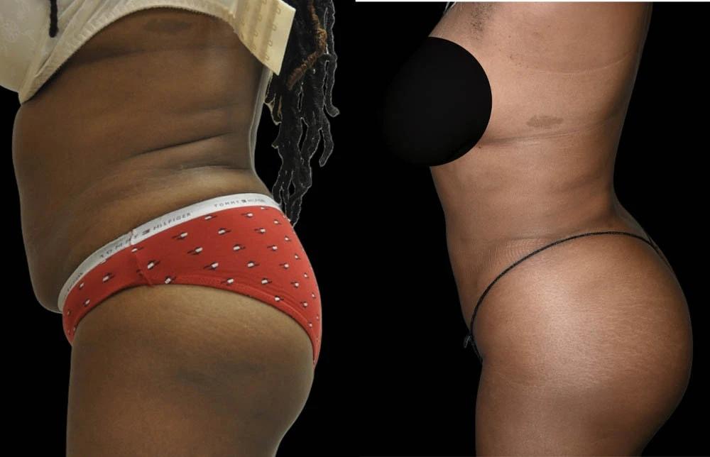 Premier Plastic Surgery (Christopher Hankins, MD) liposuction result — Pearland, TX