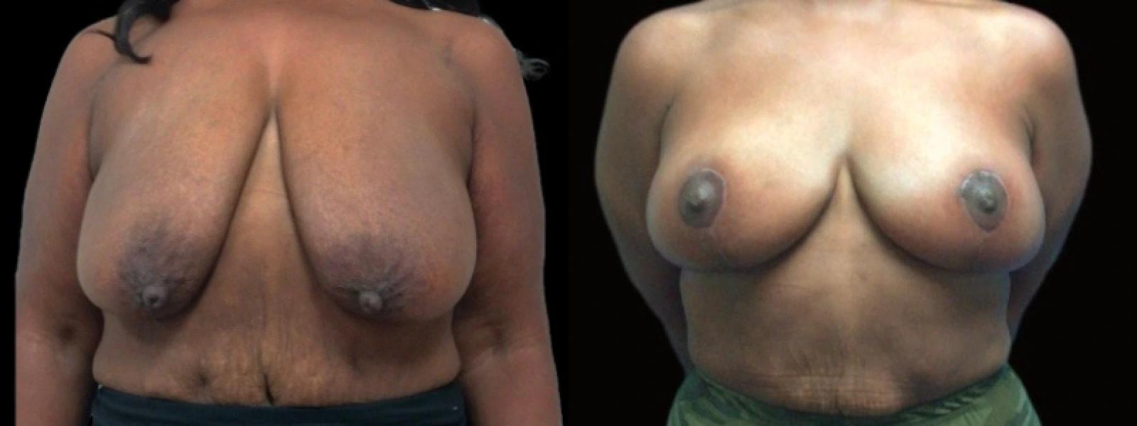 Premier Plastic Surgery (Christopher Hankins, MD) breast lift result — Pearland, TX