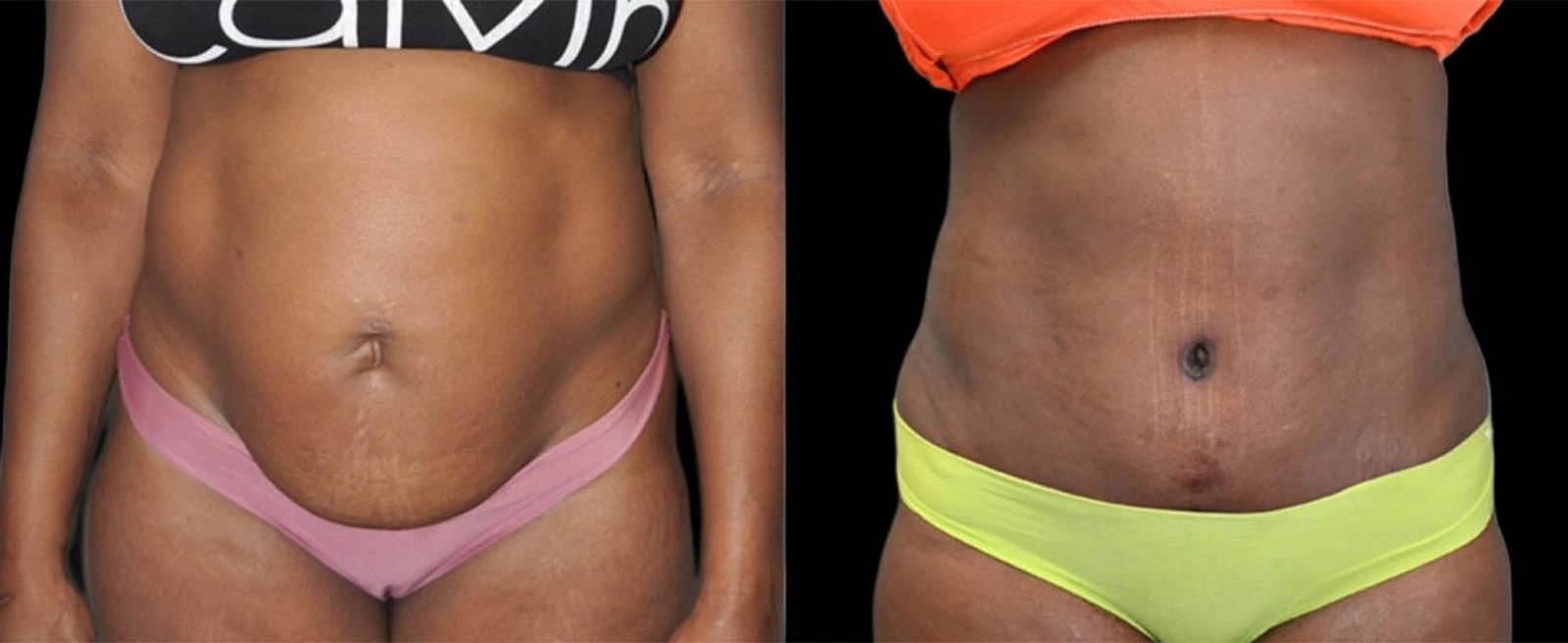 Premier Plastic Surgery (Christopher Hankins, MD) tummy tuck result — Pearland, TX