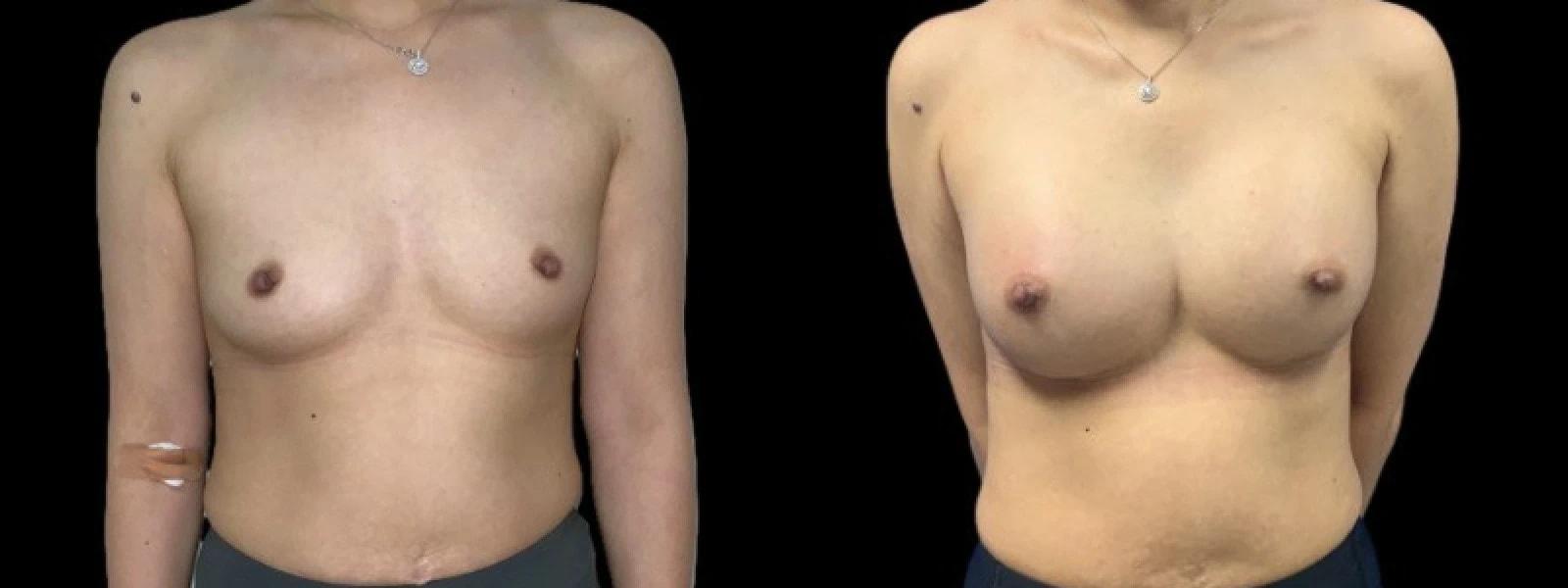 Premier Plastic Surgery (Christopher Hankins, MD) breast augmentation result — Pearland, TX
