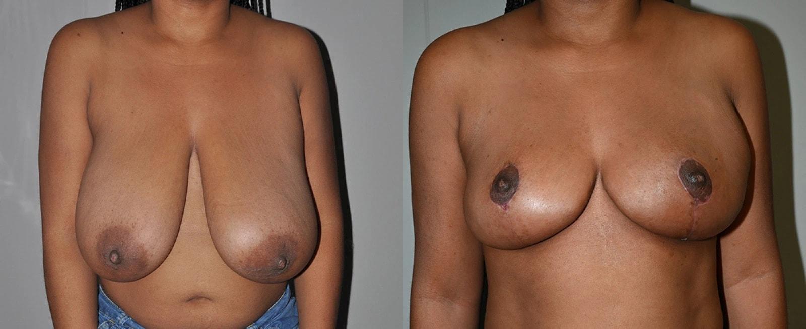 Premier Plastic Surgery (Christopher Hankins, MD) breast reduction result — Pearland, TX