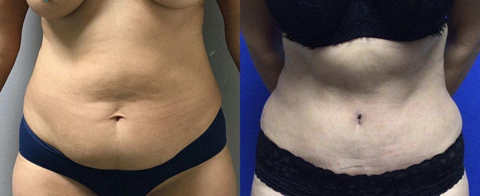 Premier Plastic Surgery (Christopher Hankins, MD) tummy tuck result — Pearland, TX