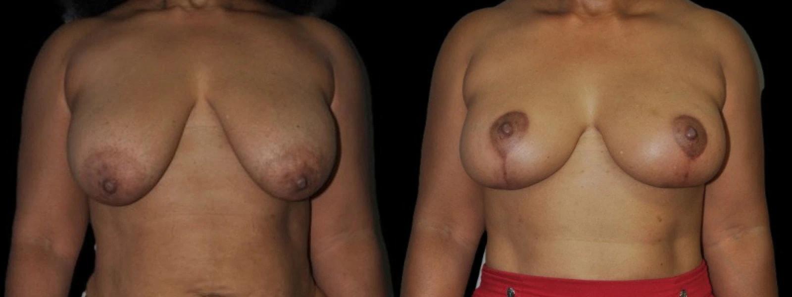 Premier Plastic Surgery (Christopher Hankins, MD) breast lift result — Pearland, TX