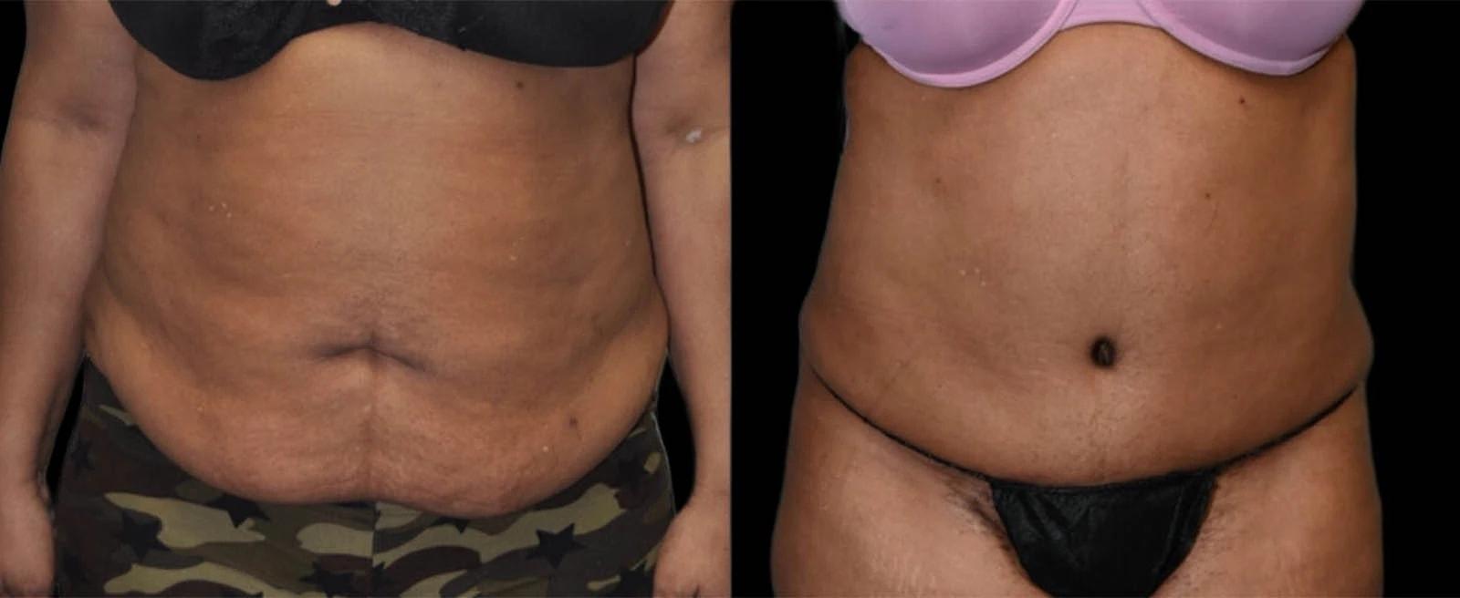 Premier Plastic Surgery (Christopher Hankins, MD) tummy tuck result — Pearland, TX