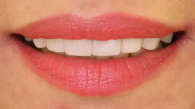 Dental Veneers after at Simply Veneers in Newport Beach, CA