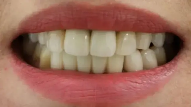 Dental Veneers before at Simply Veneers in Newport Beach, CA