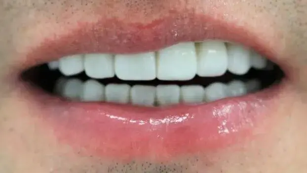 Simply Veneers veneers after — Newport Beach, CA