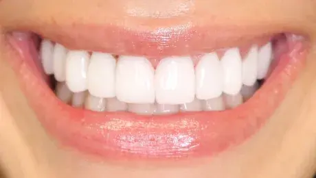 Simply Veneers veneers after — Newport Beach, CA