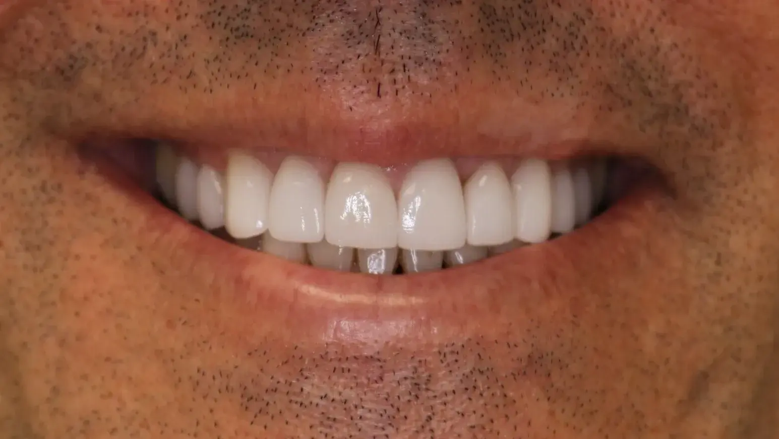 Simply Veneers veneers after — Newport Beach, CA
