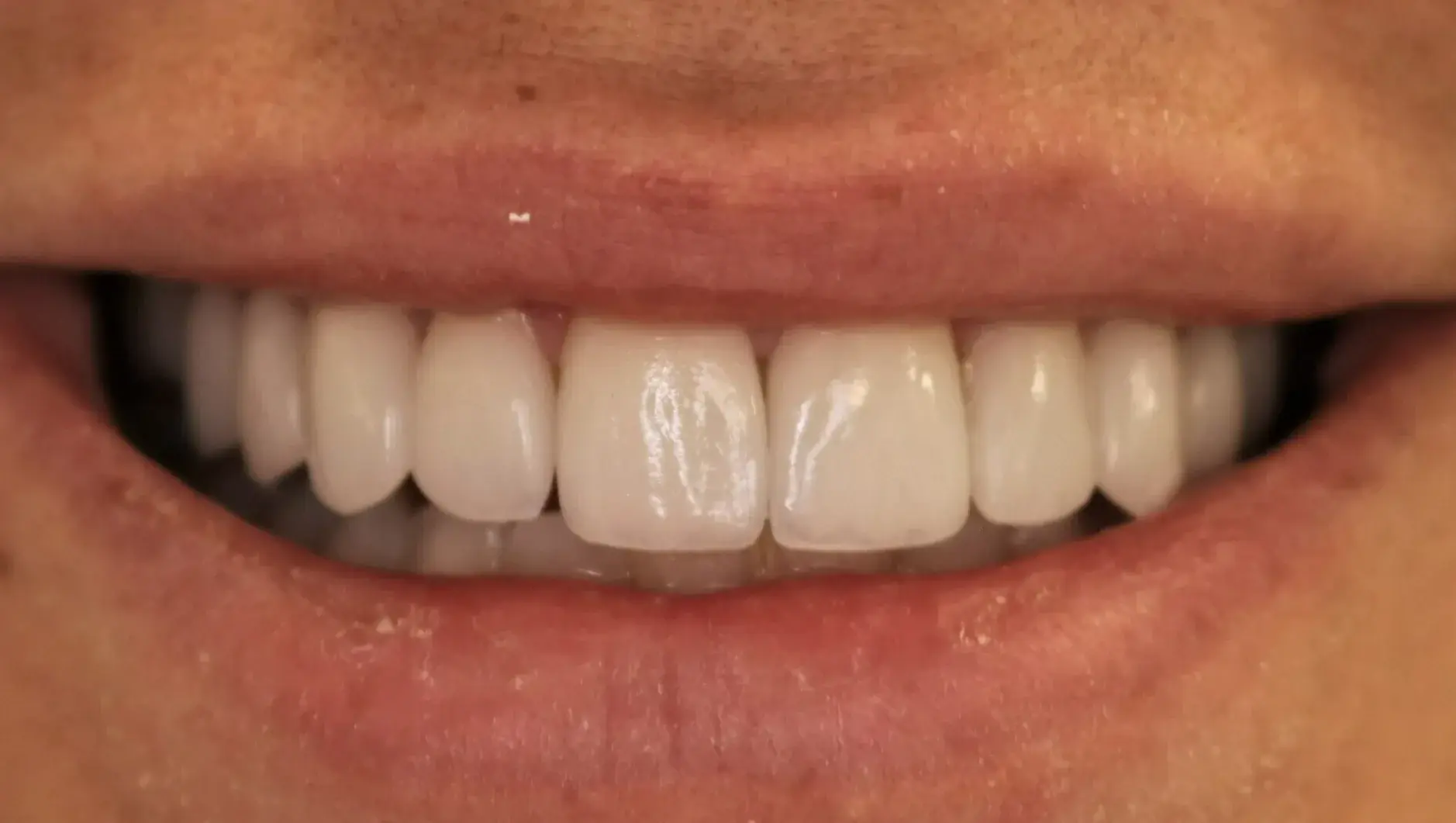 Simply Veneers veneers after — Newport Beach, CA