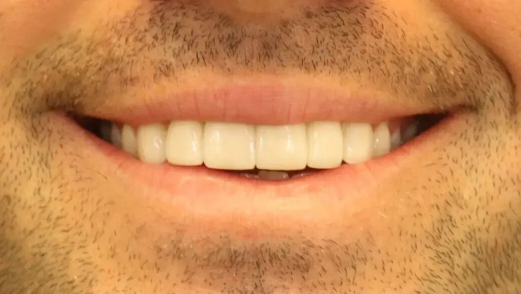 Simply Veneers veneers after — Newport Beach, CA