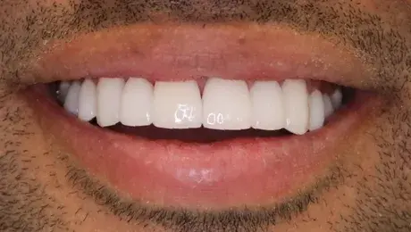 Dental Veneers after at Simply Veneers in Newport Beach, CA
