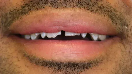 Dental Veneers before at Simply Veneers in Newport Beach, CA