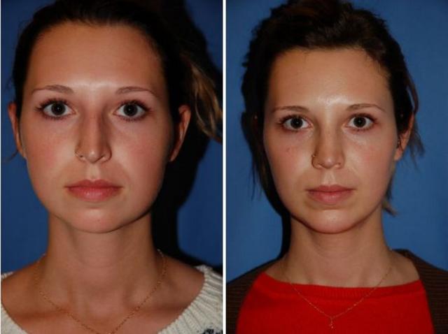 Rhinoplasty result at The Portland Center For Facial Plastic Surgery in Portland, OR