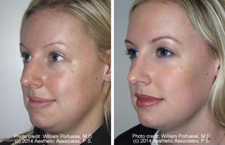 The Portland Center For Facial Plastic Surgery rhinoplasty result — Portland, OR