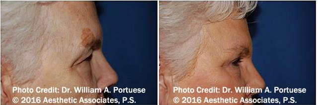 Blepharoplasty result at The Portland Center For Facial Plastic Surgery in Portland, OR