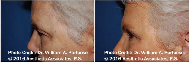 Blepharoplasty result at The Portland Center For Facial Plastic Surgery in Portland, OR
