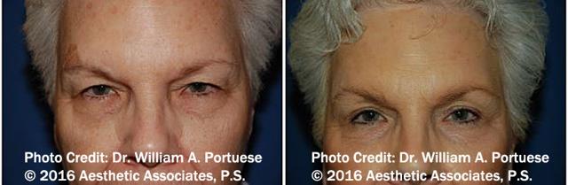Blepharoplasty result at The Portland Center For Facial Plastic Surgery in Portland, OR