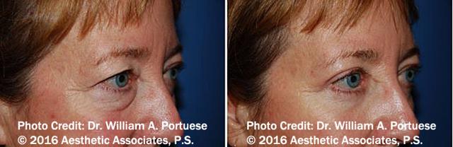 Blepharoplasty result at The Portland Center For Facial Plastic Surgery in Portland, OR