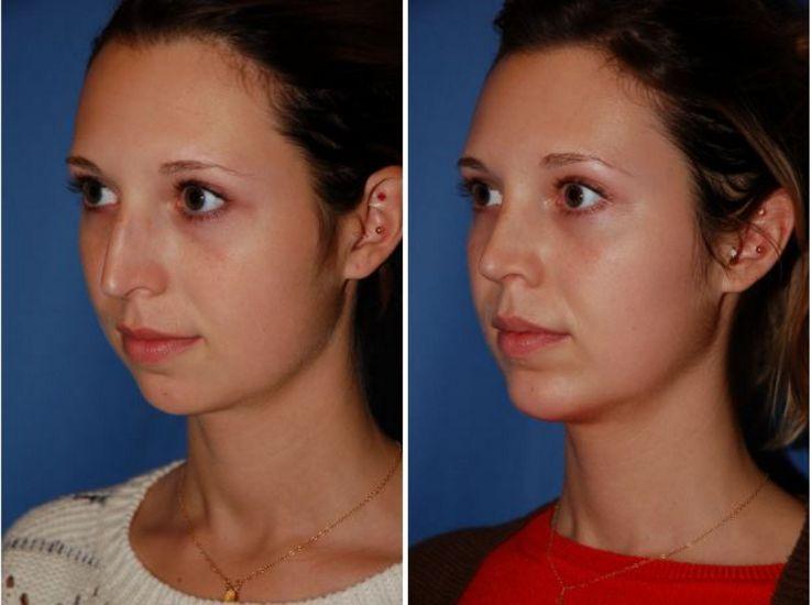 The Portland Center For Facial Plastic Surgery rhinoplasty result — Portland, OR