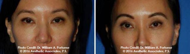 Blepharoplasty after at The Portland Center For Facial Plastic Surgery in Portland, OR