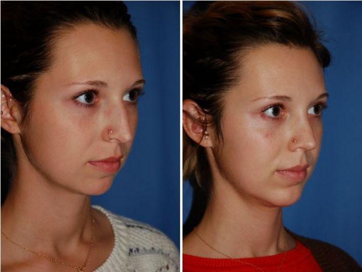 The Portland Center For Facial Plastic Surgery rhinoplasty result — Portland, OR