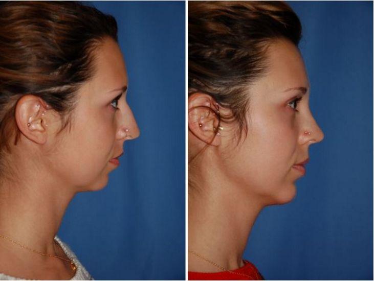 The Portland Center For Facial Plastic Surgery rhinoplasty result — Portland, OR