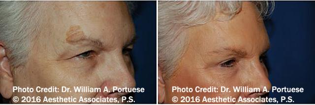 Blepharoplasty result at The Portland Center For Facial Plastic Surgery in Portland, OR