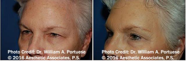 Blepharoplasty result at The Portland Center For Facial Plastic Surgery in Portland, OR