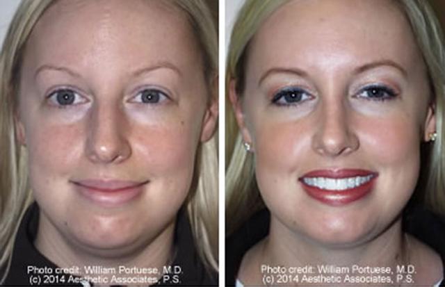Rhinoplasty after at The Portland Center For Facial Plastic Surgery in Portland, OR