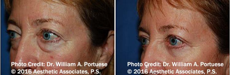 The Portland Center For Facial Plastic Surgery eyelid lift result — Portland, OR