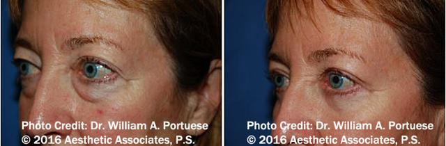 Blepharoplasty result at The Portland Center For Facial Plastic Surgery in Portland, OR